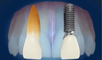 Implant zęba – jakie są rodzaje implantów, ile kosztuje, cena implantów na rynku.